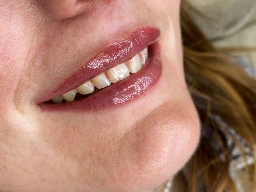 Lippen cliënt B na PMU