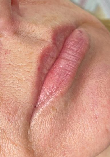 Lippen cliënt A voor PMU