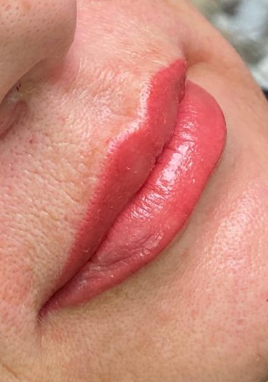 Lippen cliënt A na PMU