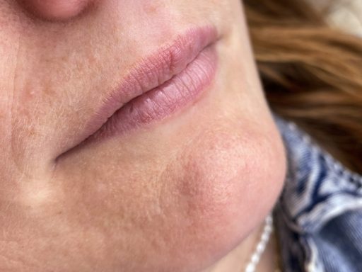 Lippen cliënt B voor PMU