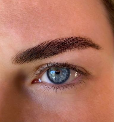 Brow Lift